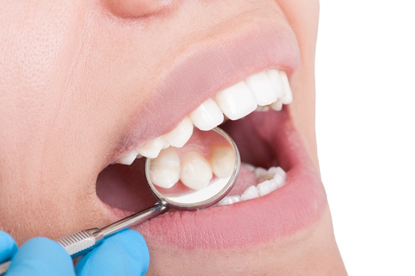 Treat Cavities With Composite Fillings