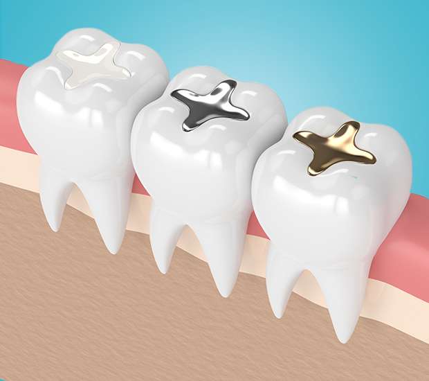 Colorado Springs Composite Fillings