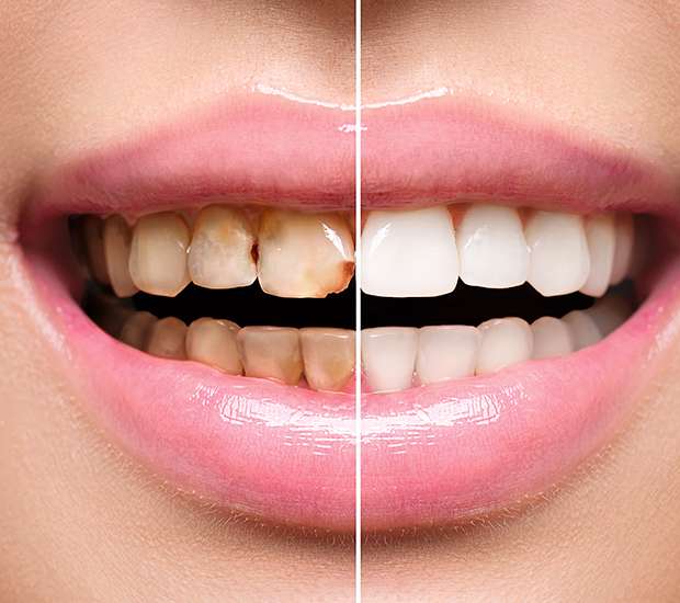 Colorado Springs Dental Implant Restoration