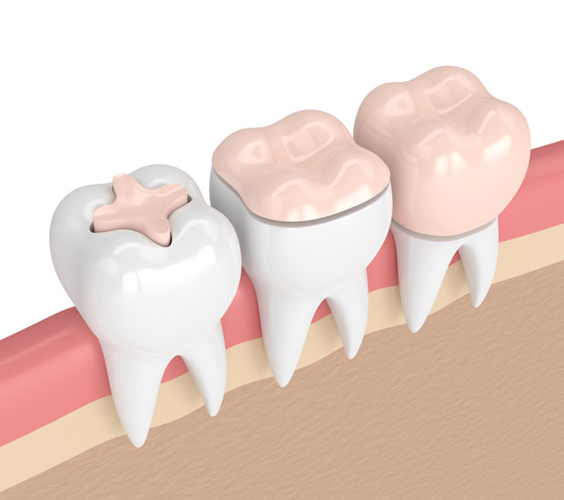 Colorado Springs Dental Inlays and Onlays