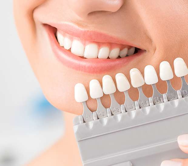 Colorado Springs Dental Veneers and Dental Laminates