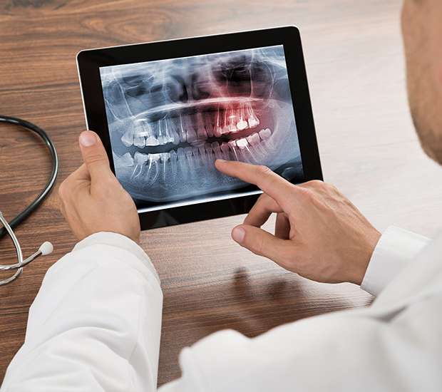 Colorado Springs Types of Dental Root Fractures